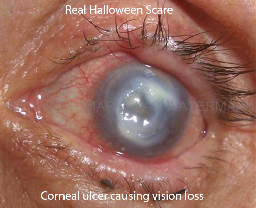 corneal ulcer